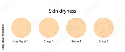 Skin dryness photo