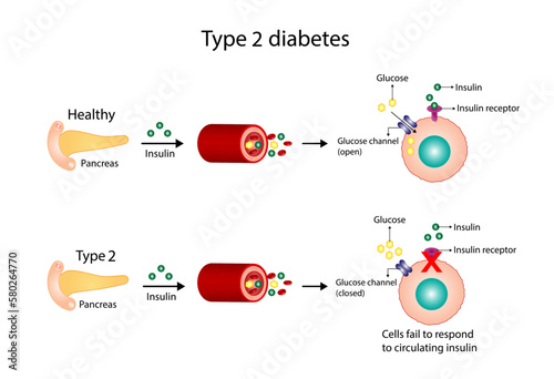 Diabetes mellitus type 2, cells fail to respond to insulin (Insulin resistance). high blood glucose levels. Vector Diagram illustration. photo