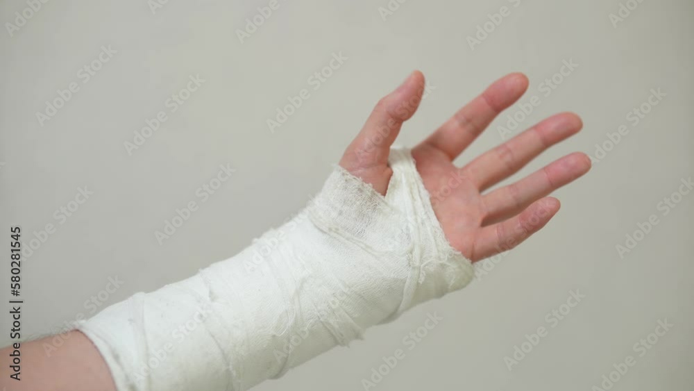 Man with plaster cast on arm. A broken arm in plaster. Man with plaster cast on arm. A broken arm in plaster.