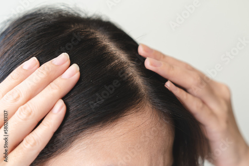Cuadro en lienzo close up on hair of people have a dandruff on the head