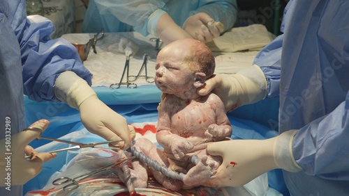 The doctor removes the baby from the mother's abdomen and cuts the umbilical cord. The process of cutting the umbilical cord of a newborn baby close-up. Childbirth by caesarean section. photo