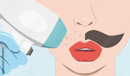 Elos epilation hair removal procedure on a woman’s body. Beautician doing laser rejuvenation in a beauty salon. Removing unwanted body hair. Hardware ipl cosmetology