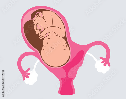 Vector illustration of bicornuate uterus during pregnancy. One uterine with fetus child and second cavity is empty and separated with septum
