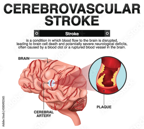 Informative poster of Cerebrovascular stroke