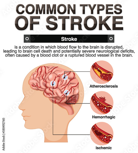 Informative poster of common types of stoke