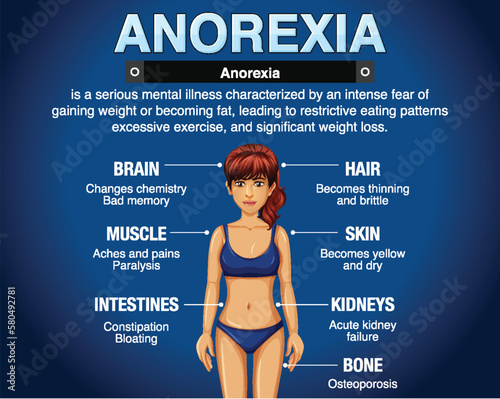 Informative poster of Anorexia eating disorder