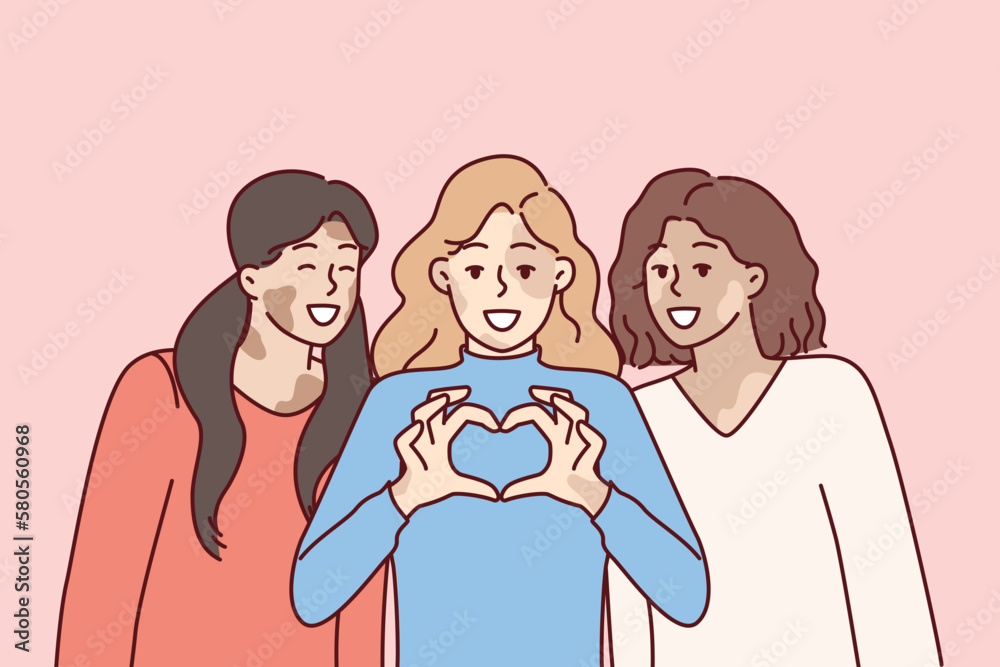 Three women with vitiligo syndrome are smiling demonstrating heart gesture as sign of self-love. Girl friends congratulate on vitiligo day calling for tolerance to people with depifmentation of skin