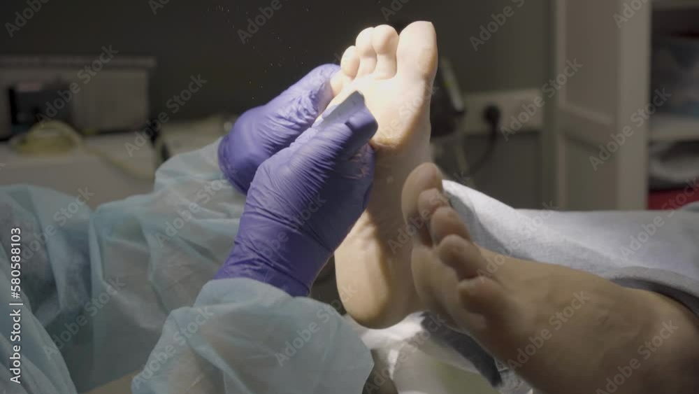 Podiatrist removes dry skin from the sole of a patient's foot in clinic. High quality 4k footage Podiatrist removes dry skin from the sole of a patient's foot in clinic. High quality 4k footage