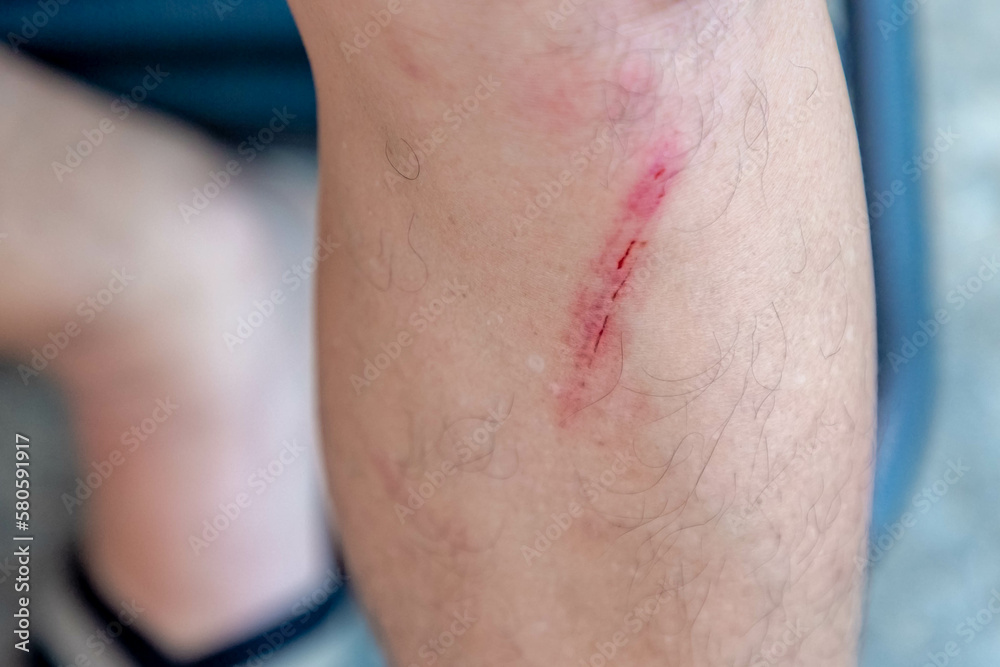 First aid and injuries concept, A man showing a little bit lesion, Accident wound or abrasion marks on the left side shin, Healthcare and medical background.