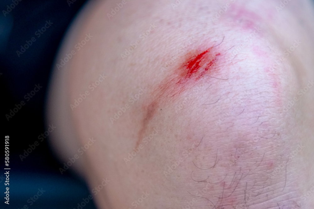 First aid and injuries concept, A man showing a little bit lesion, Accident wound or abrasion marks on the left side knee, Healthcare and medical background. First aid and injuries concept, A man showing a little bit lesion, Accident wound or abrasion marks on the left side knee, Healthcare and medical background.
