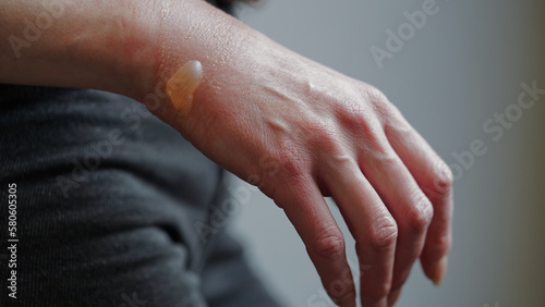 Close-up of a woman's hand with a blister from a boiled water burn, damaged skin, 1st or second degree burn. Painful wound. Thermal burn. Water bladder from a burn, wound treatment.Macro photo