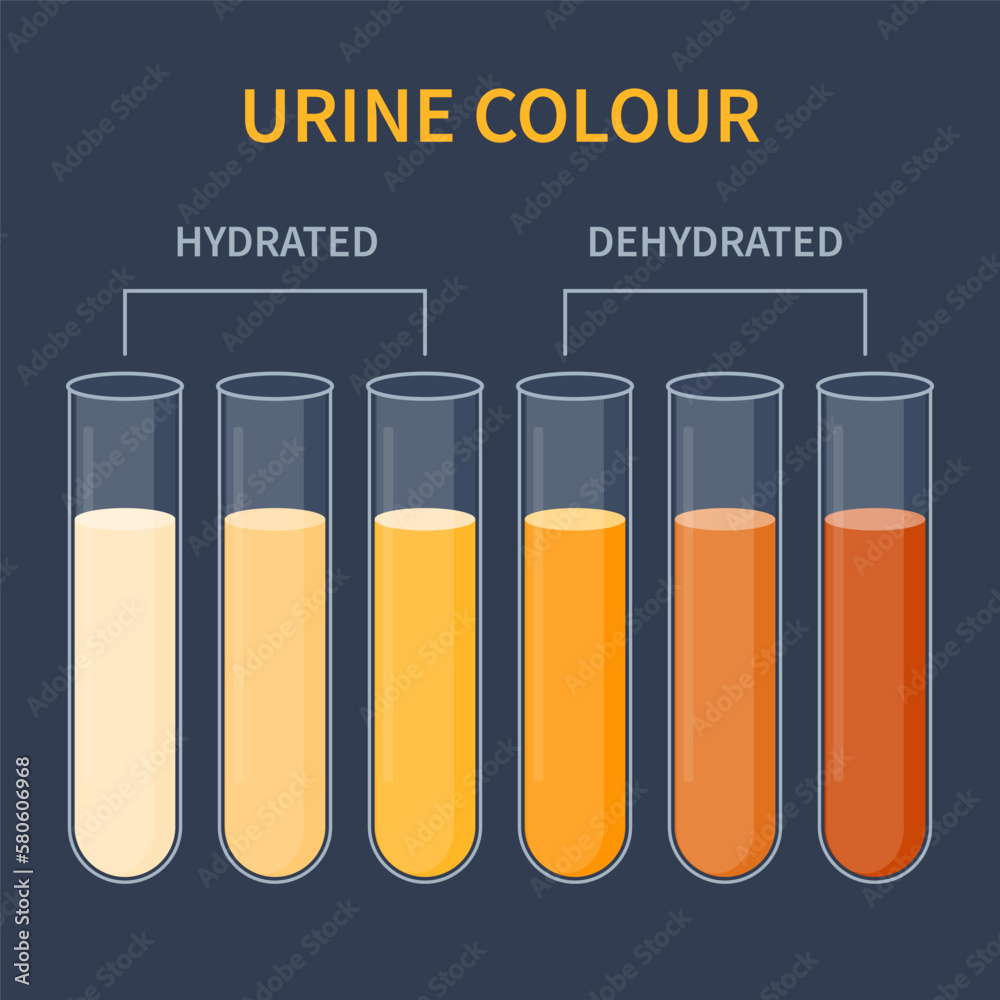 Urine colour chart. Hydration and dehydration level diagram. Medical