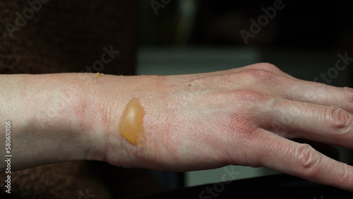 Close-up of a woman's hand with a blister from a boiled water burn, damaged skin, 1st or second degree burn. Painful wound. Thermal burn. Water bladder from a burn, wound treatment.Macro photo