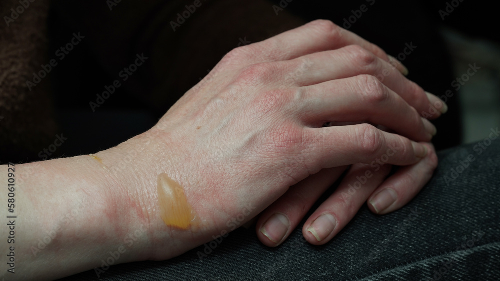 Fototapeta premium Close-up of a woman's hand with a blister from a boiled water burn, damaged skin, 1st or second degree burn. Painful wound. Thermal burn. Water bladder from a burn, wound treatment.Macro photo