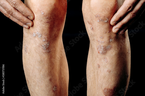 Acute psoriasis on the legs is an autoimmune incurable dermatological skin disease. A large red, inflamed, scaly rash on the knees. Joints affected by psoriatic arthritis
