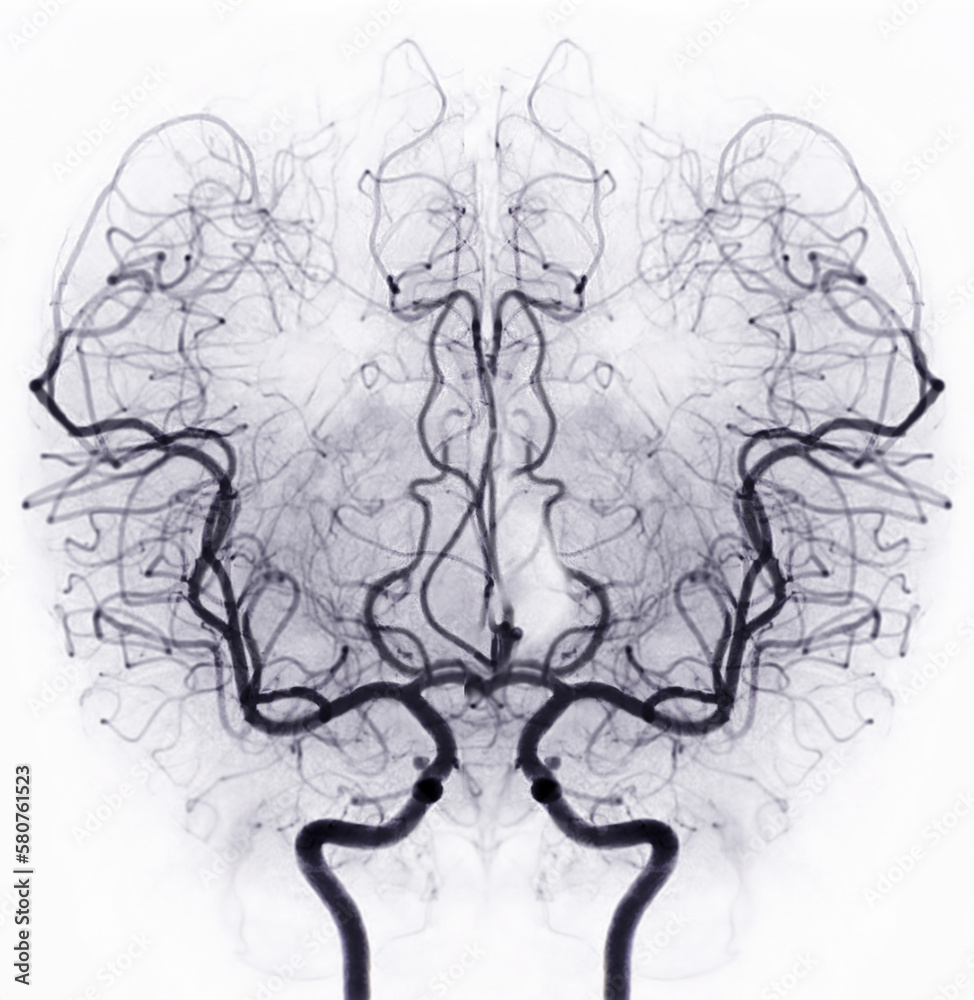 Cerebral angiography image from Fluoroscopy in intervention radiology showing cerebral artery. Cerebral angiography image from Fluoroscopy in intervention radiology showing cerebral artery.