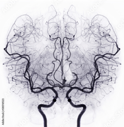 Cerebral angiography  image from Fluoroscopy in intervention radiology  showing cerebral artery.