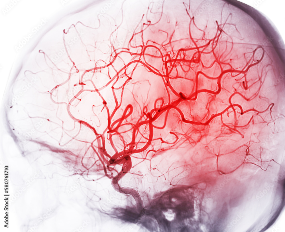 Cerebral angiography image from Fluoroscopy in intervention radiology