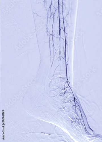 Femoral artery angiogram or angiography  at lower extremity area. photo