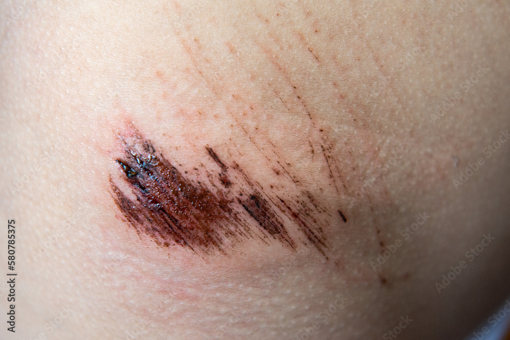 Close-up of a wound on the child's skin, skin pain, patient Close-up of a wound on the child's skin, skin pain, patient