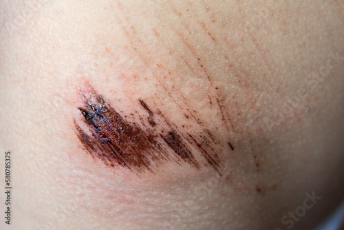 Close-up of a wound on the child's skin, skin pain, patient