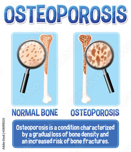 Informative poster of Osteoporosis human bone