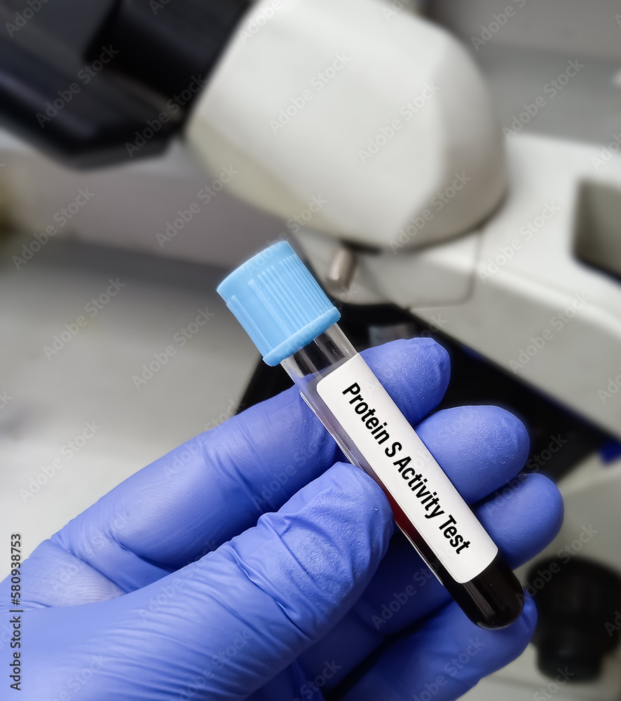 Blood sample for protein S activity test to diagnosis of coagulation