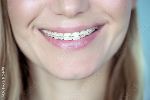 Adult woman with a braces