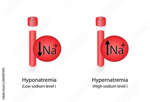 Hypernatremia, high plasma sodium level and Hyponatremia, low plasma sodium level. Sodium Na excess and deficit electrolyte disorders, blood test tube, Scientific design. Vector illustration.