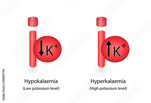 Hyperkalaemia, high plasma potassium level and Hypokalaemia, low plasma potassium level. Potassium K excess and deficit electrolyte disorders, blood test tube, Scientific design. Vector illustration.