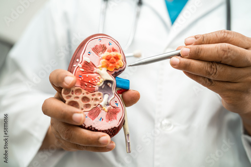 Konstfotografi Kidney disease, Chronic kidney disease ckd, Doctor hold model to study and treat in hospital