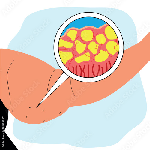 Fat arm of woman. Lipedema fat deposits. Liposuction concept