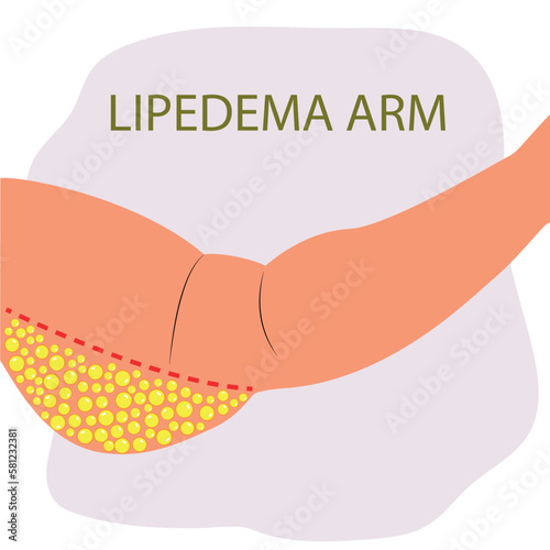 Fat arm of woman. Lipedema fat deposits. Liposuction concept