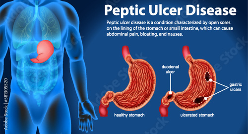 Peptic Ulcer Disease Infographic