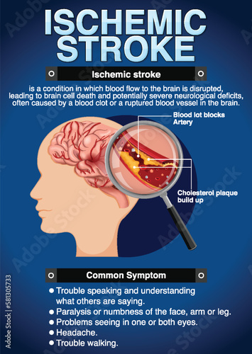 Informative poster of Ischemic stroke