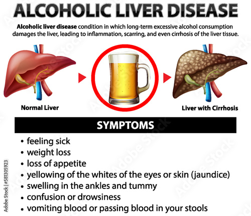 Informative poster of alcoholic liver disease Cirrhosis