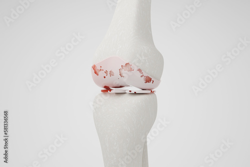 Knee osteoarthritis isolated white background 3D rendering. photo