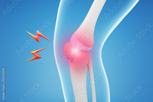 X ray of Knee pain on blue background. 3D rendering. photo