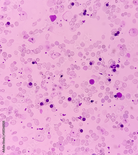 Hereditary hemolytic anemia. Hemoglobin E (HbE) disease. Smear show 90 nRBC100 wbc, pencil cell, target cell, tear drop cell. Thalassemia disease. photo