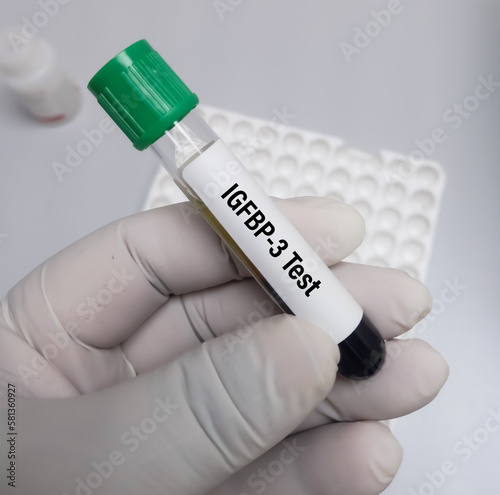 Blood samples for IGFBP-3(IGF binding protein-3) test or insulin like growth factor binding protein 3. photo