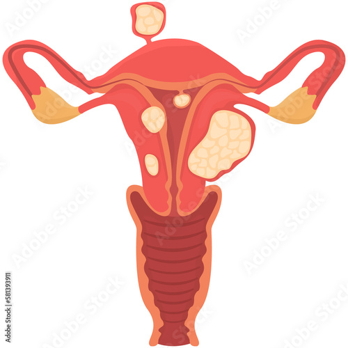 Uterine fibroids, myoma, uterine leiomyomas in reproductive system png  photo