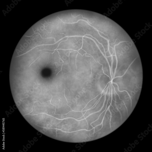 Best vitelliform macular dystrophy, vitelliform stage, classic egg-yolk lesion, illustration, fluorescein angiography photo