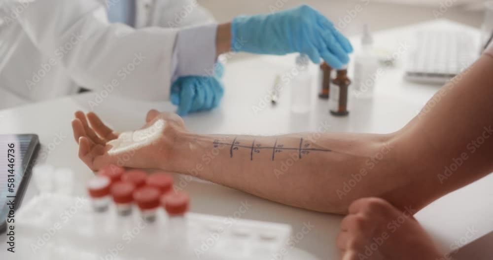 Close Up of a Patient Passing a Prick Scratch Allergy Test. Allergist Using Different Allergens on a Skin of a Young Man. Immunologist Diagnosing Allergy Triggers