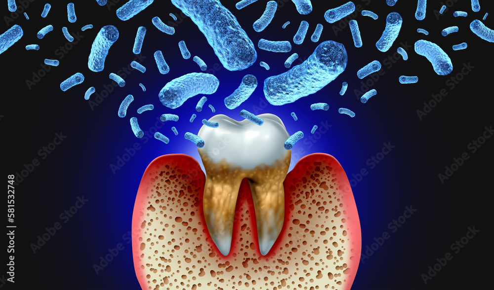Bacterial tooth infection and teeth decay disease as an unhealthy molar