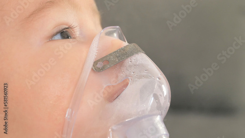 Close up of little baby boy is treated respiratory problem with vapor nebulizer to relief cough symptom in the hospital room , concept of pediatric patient care for sick in the hospital.