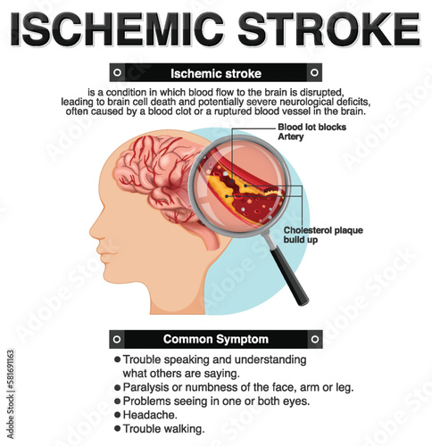 Informative poster of Ischemic stroke