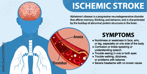 Informative poster of Ischemic stroke