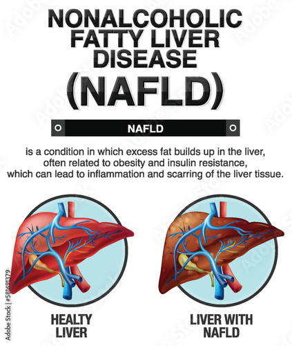 Nonalcoholic fatty liver disease photo