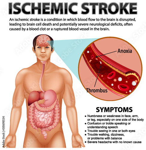 Informative poster of Ischemic stroke