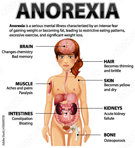 Informative poster of Anorexia eating disorder